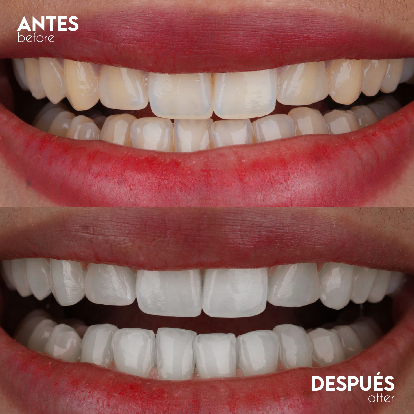 Caso Blanqueamiento - Antes y Después