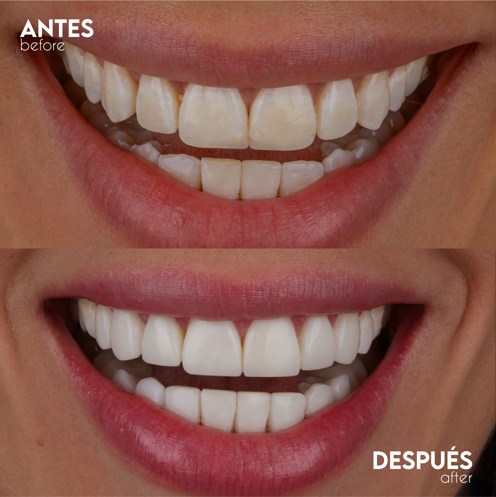 Caso Mini - Antes y Después
