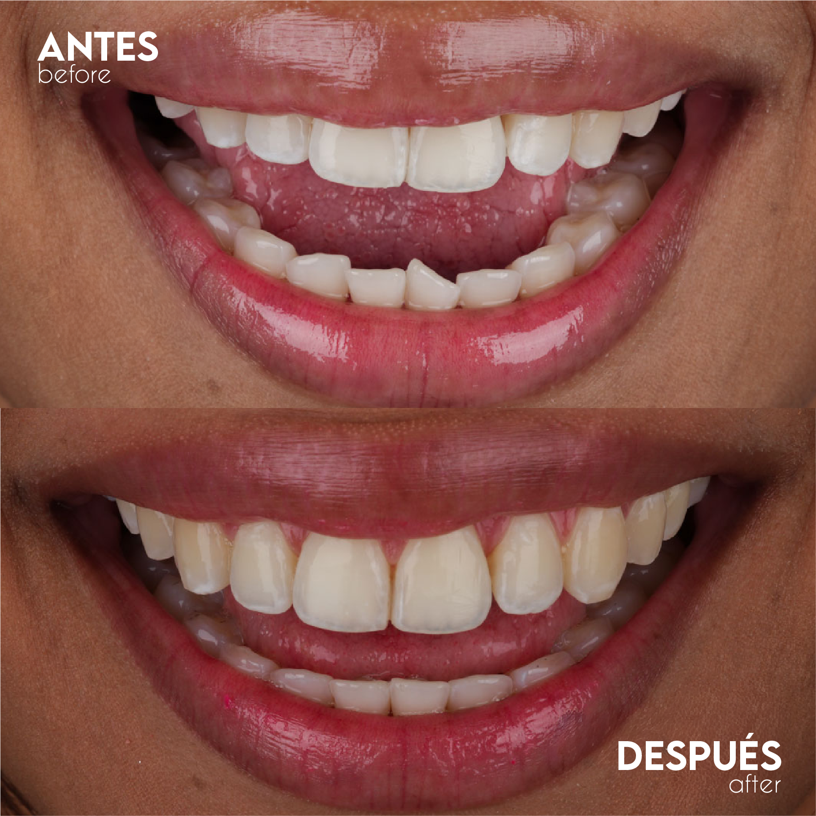 Caso Ortodoncia - Antes y Después