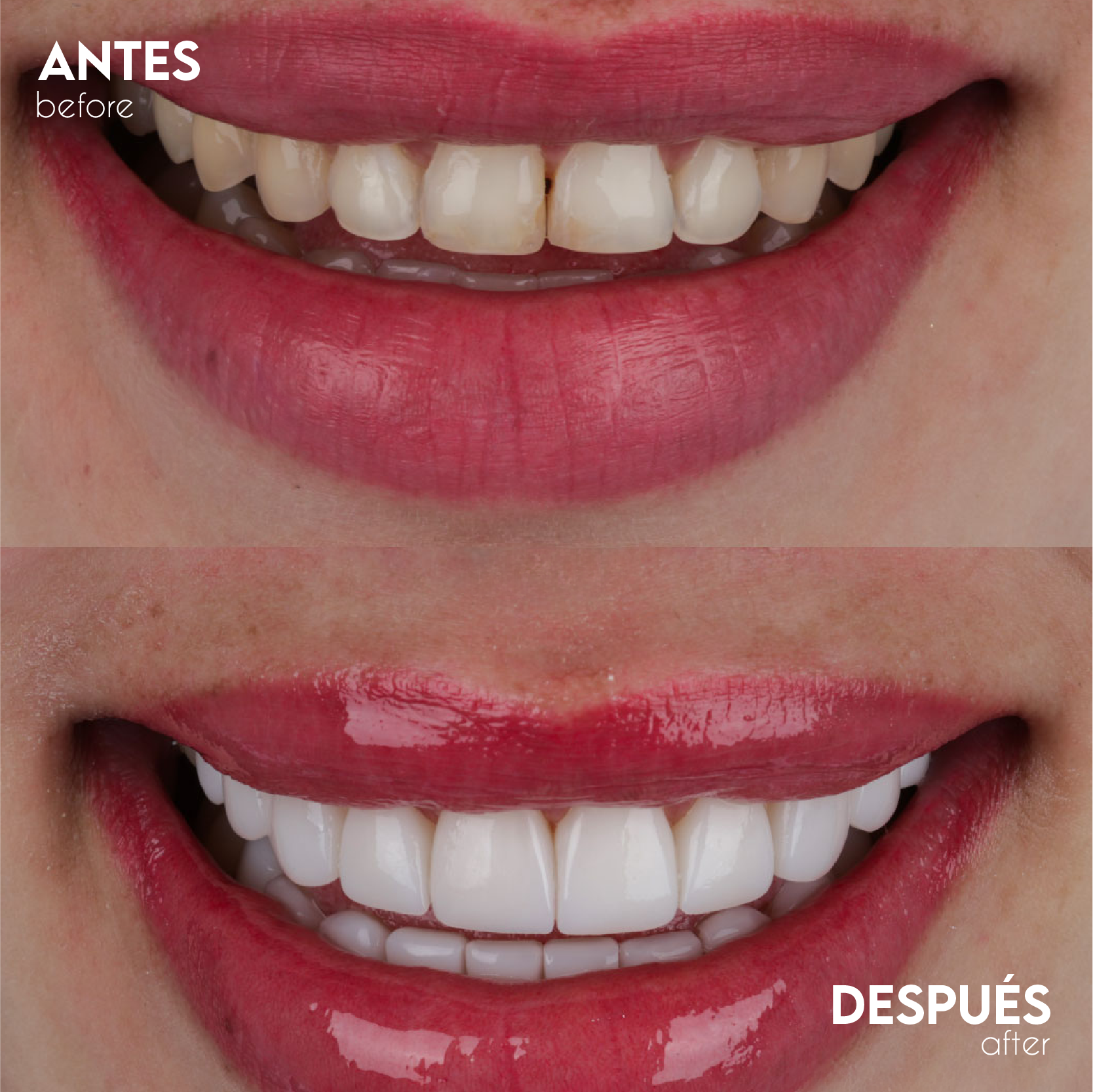 Caso Resina - Antes y Después