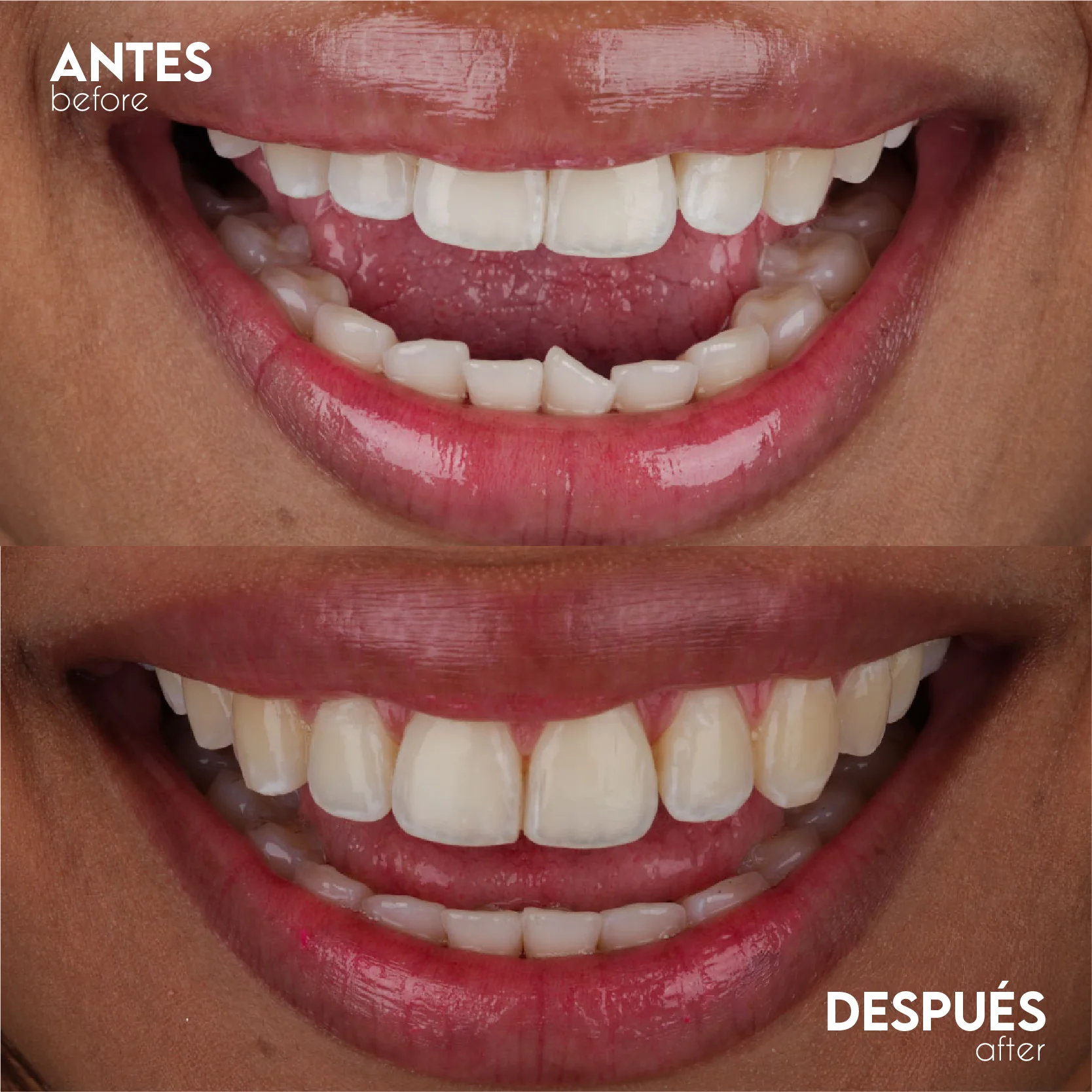 Caso Ortodoncia - Antes y Después