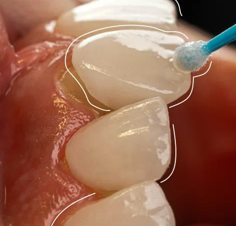 Dra Diana Pulgarin Dental Group Diseño de sonrisa: lo que conviene saber antes de dar el paso  Image of Sobre la clinica 471x450 Diseño de sonrisa