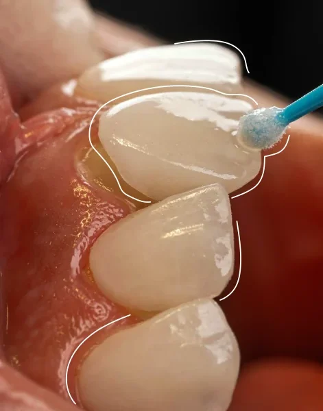 Dra Diana Pulgarin Dental Group Resina o cerámica: cómo elegir el material de su diseño de sonrisa  Image of Sobre la clinica 471x600 Diseño de sonrisa