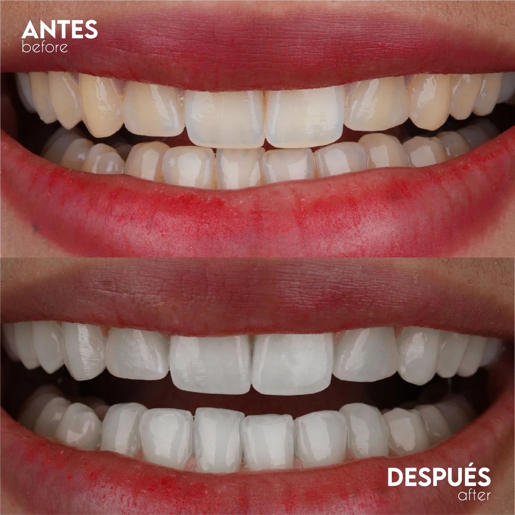 Caso Blanqueamiento - Antes y Después